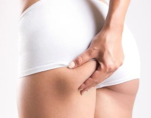 Vetcellulite